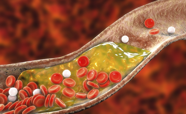 arteriopatia periferica: sintomi e cause