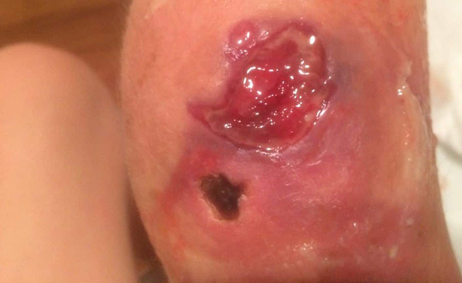 ulcera carnivora: epidemia in Australia