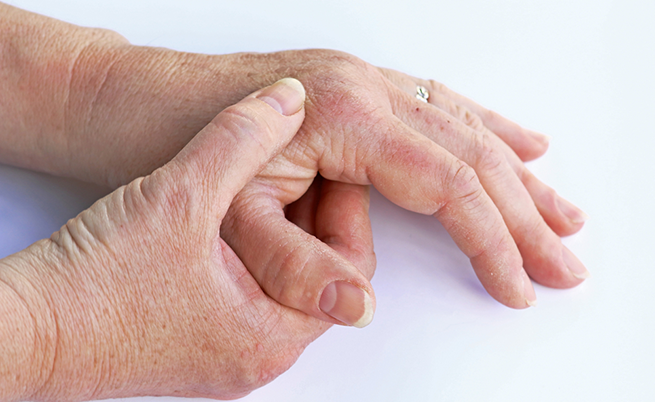 La cura per l'artrite psorisiaca