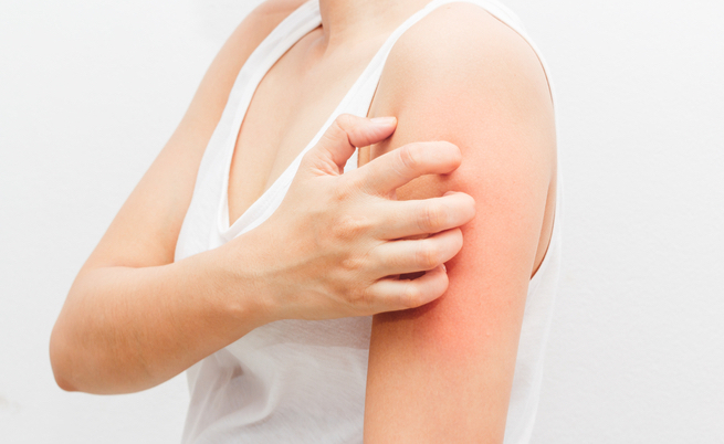 prurigo nodulare: cause e rimedi