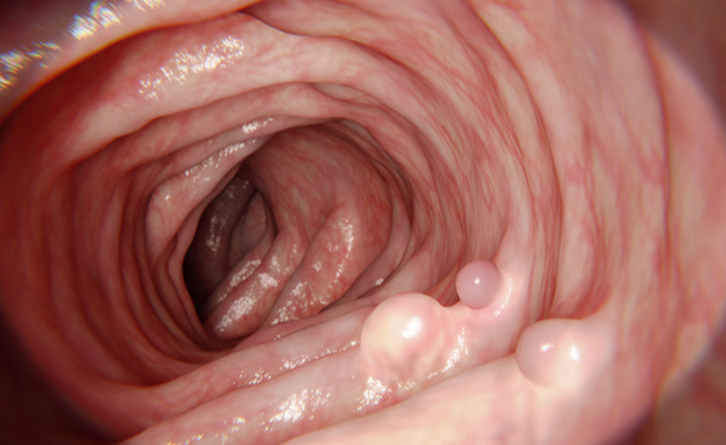 Polipectomia: l'asportazione di un polipo