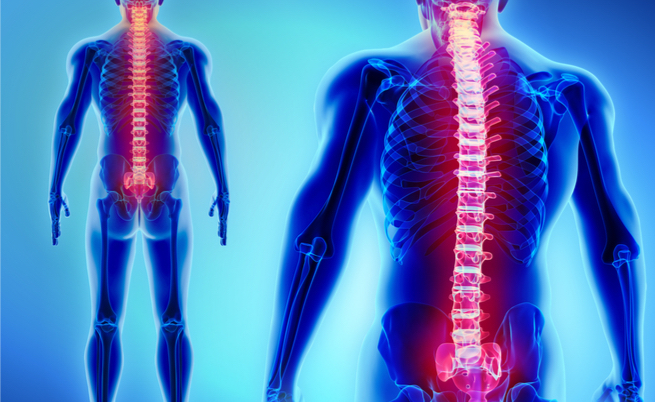 radicolopatia: sintomi, cause e cure