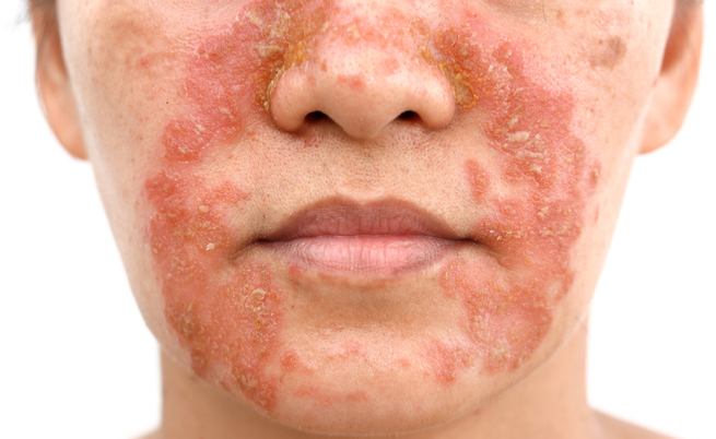 dermatite seborroica in primavera: sintomi, cause e rimedi