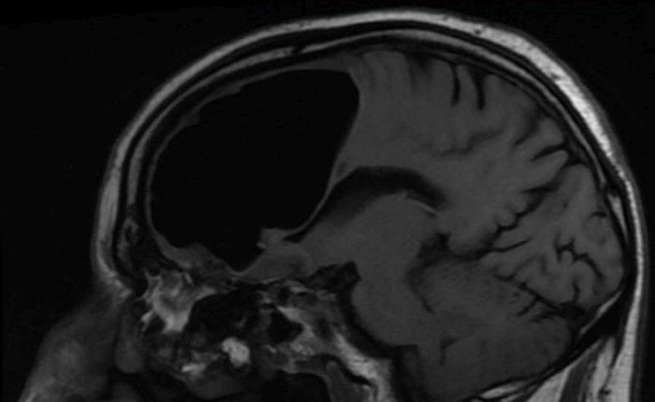 Pneumocefalo: una bolla d'aria nel cervello