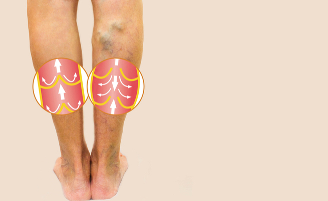Problemi di circolazione sanguigna: i sintomi per riconoscerli
