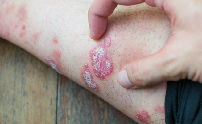 Conseguenze della psoriasi: pressione alta, diabete, malattie metaboliche
