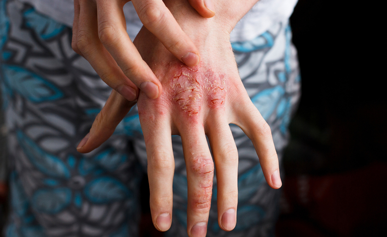 eczema sulle mani: le cause e i rimedi per la dermatite da contatto.