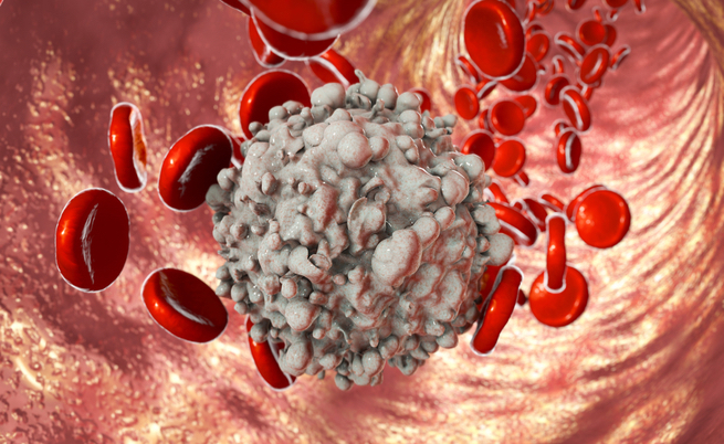 tumori infantili: sintomi, cause e cure