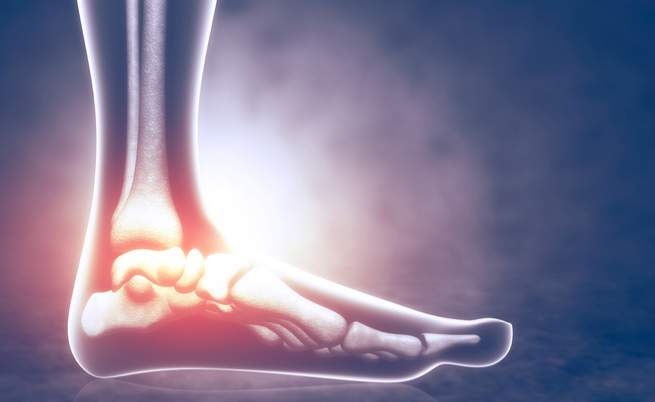 intervento chirurgico per l'artrosi del piede: cosa comporta e come si esegue