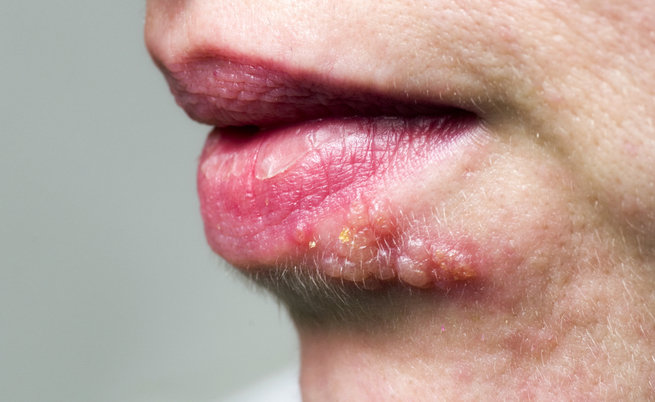 Herpes labiale: sintomi, cause e contagio