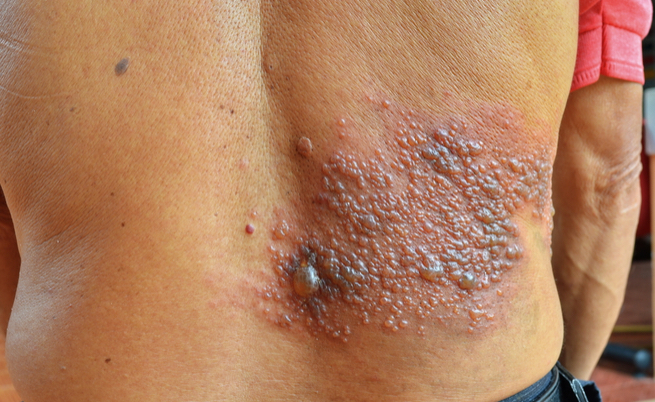 herpes zoster e fuoco di Sant'Antonio: sintomi e contagio