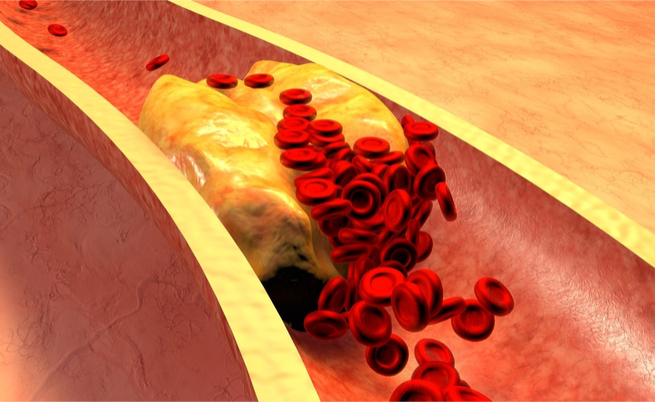 carbone vegetale per colesterolo: ecco come abbassarlo con rimedi omeopatici