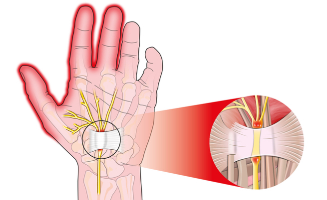Come curare il tunnel carpale