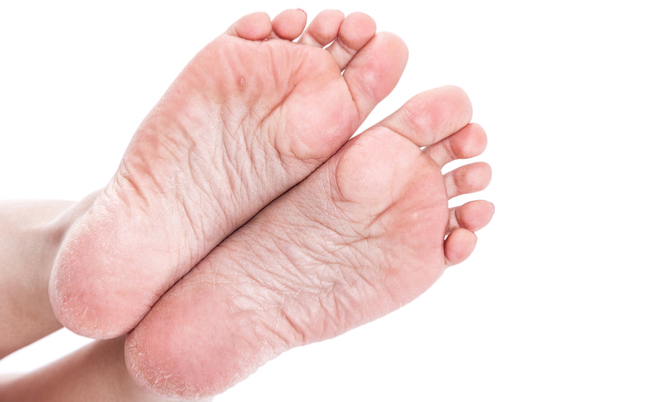 Rimedi per geloni a mani e piedi