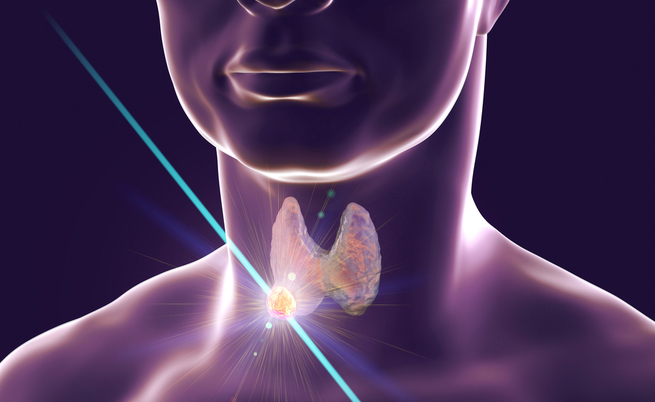 Nodulo alla tiroide: sintomi e cura