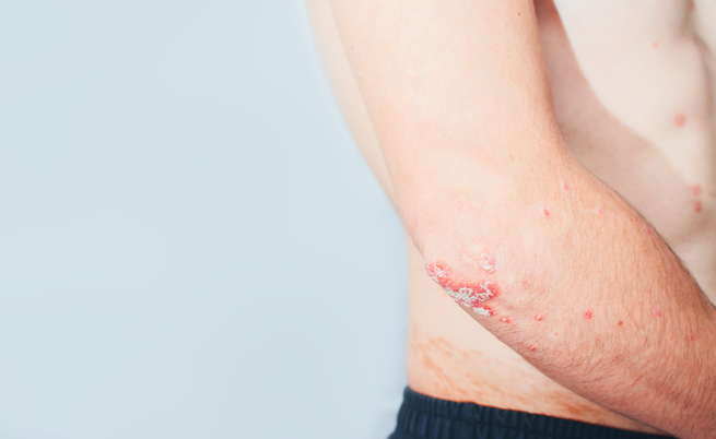 Fototerapia per malattie della pelle: psoriasi, dermatite ed eczema