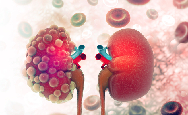 Sintomi Nefrite: ecco i principali