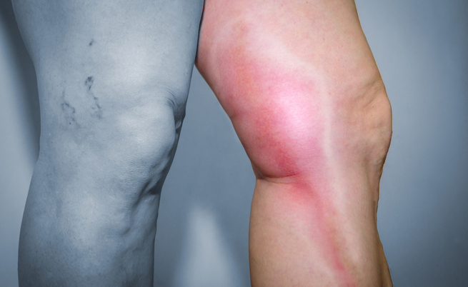 I sintomi della flebite, e non solo: cura, diagnosi e cause