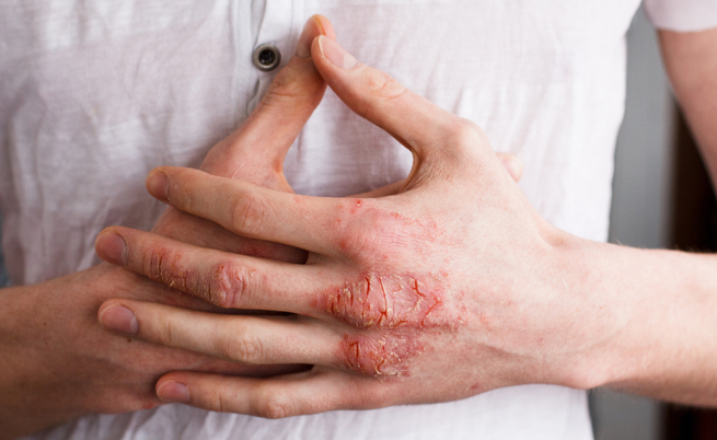 Eczema: sintomi, cause e cure