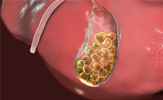 Calcoli biliari: cause, sintomi e cure