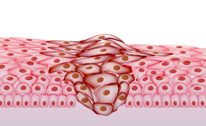 Carciofi: perché proteggono dai tumori