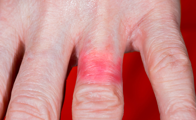 Allergia al nichel: sintomi e cure