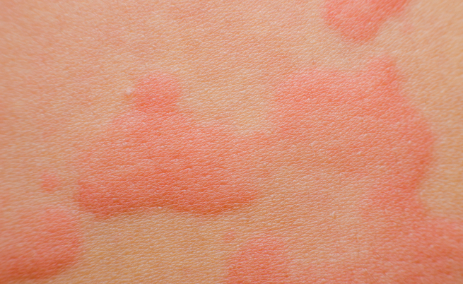 Allergia all'acqua: sintomi, cause e rimedi