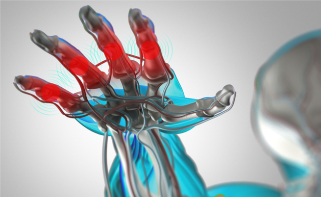 Farmaco artrite reumatoide: il Baricitinib