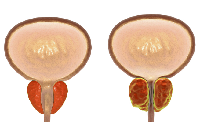 Dimensioni prostata: ecco quali sono quelle corrette