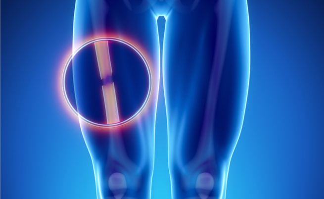 Il percorso di riabilitazione delle frattura del femore