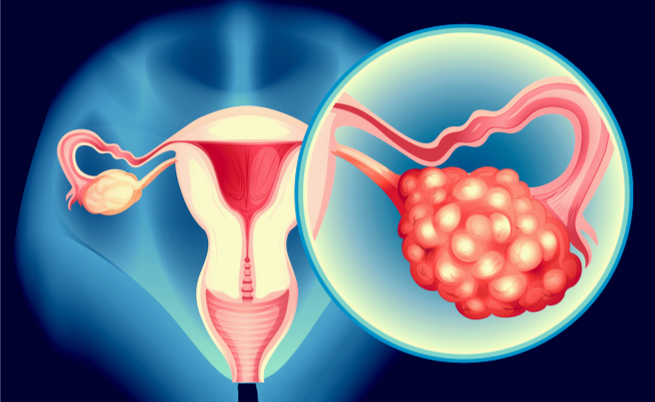 Tumore all'ovaio: il farmaco Niraparib