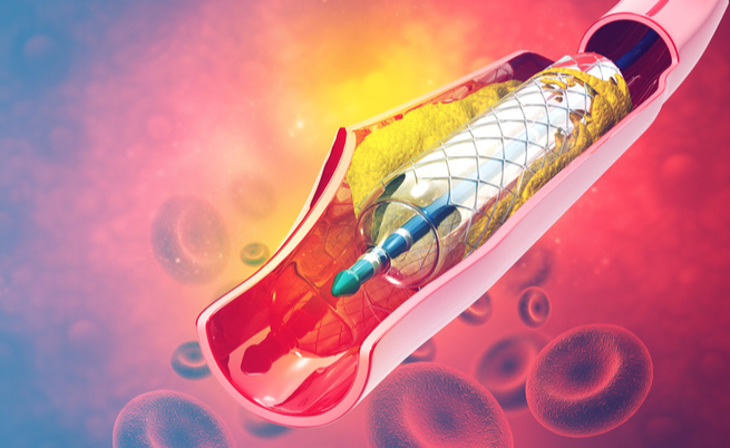 Sclerosi multipla e angioplastica: è efficace oppure no?