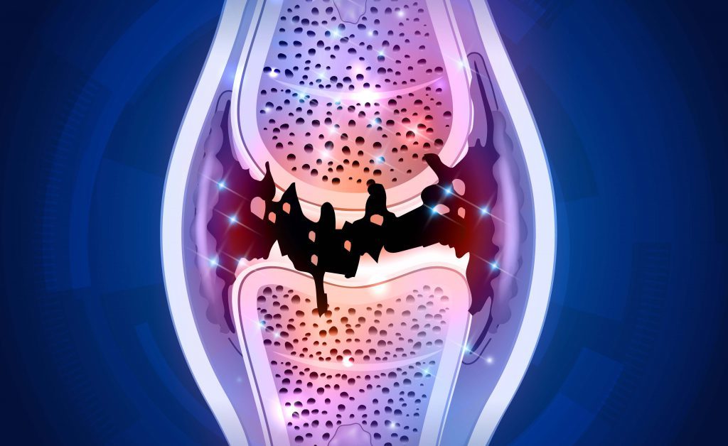 dolori articolari in menopausa: come trattarli naturalmente