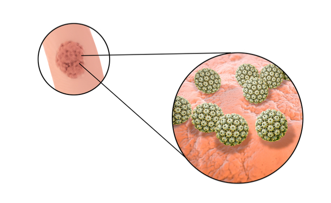 Condilomi genitali: cause, sintomi e vaccinazione