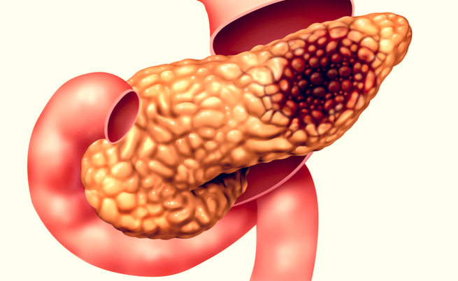 Tumore al pancreas: la sopravvivenza è legata a 4 geni