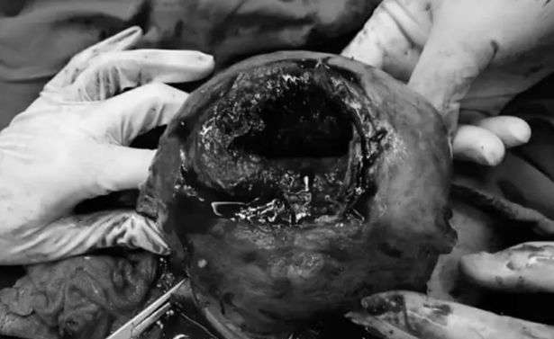 Rottura dell'utero in gravidanza: quando può accadere