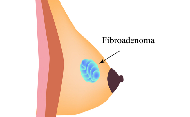 Nodulo al seno: il fibroadenoma, formazione benigna