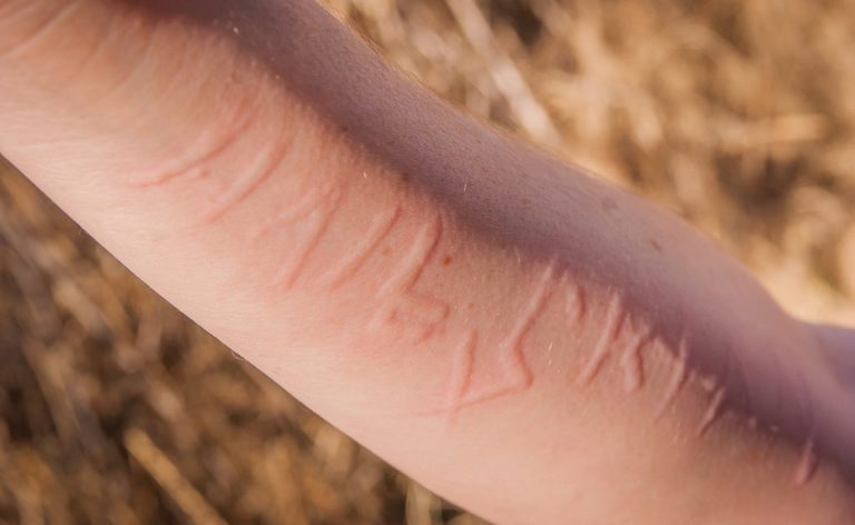 dermatografia dermatografia: cos'è e come curarla