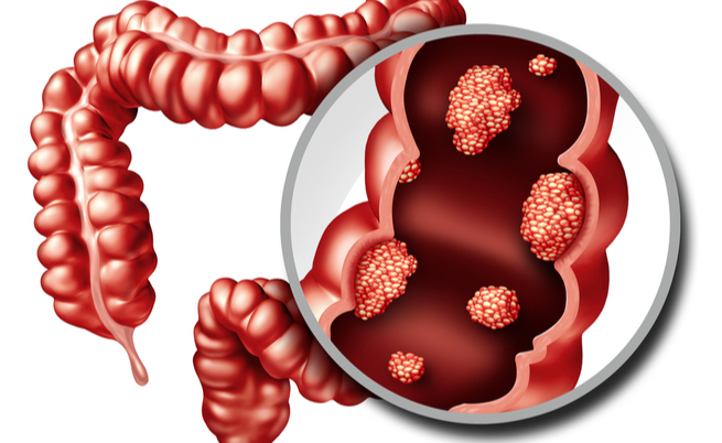 La carne rossa è cancerogena?