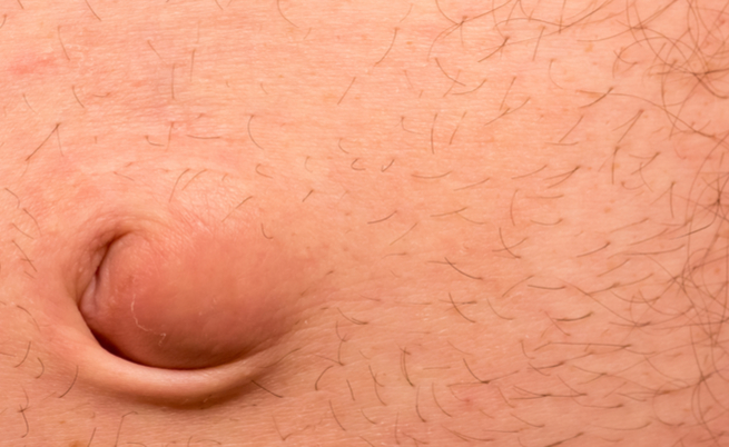 Ernia ombelicale: quando intervenire?