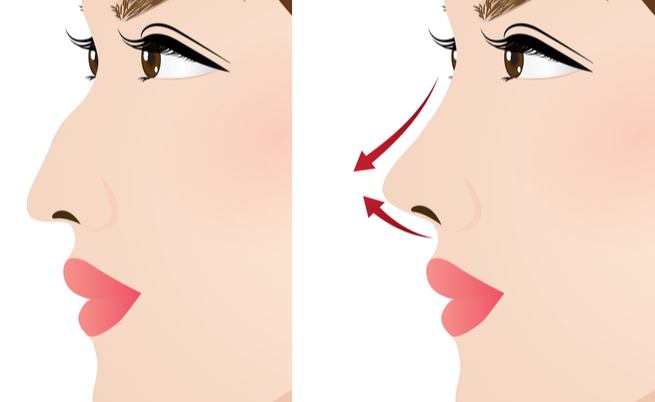 Chirurgia al naso: i giorni dopo una rinoplastica