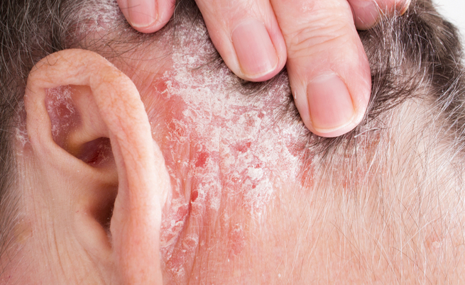 Una nuova cura per la psoriasi