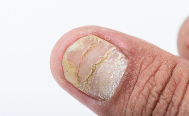 Psoriasi: cos'è e le zone più colpite