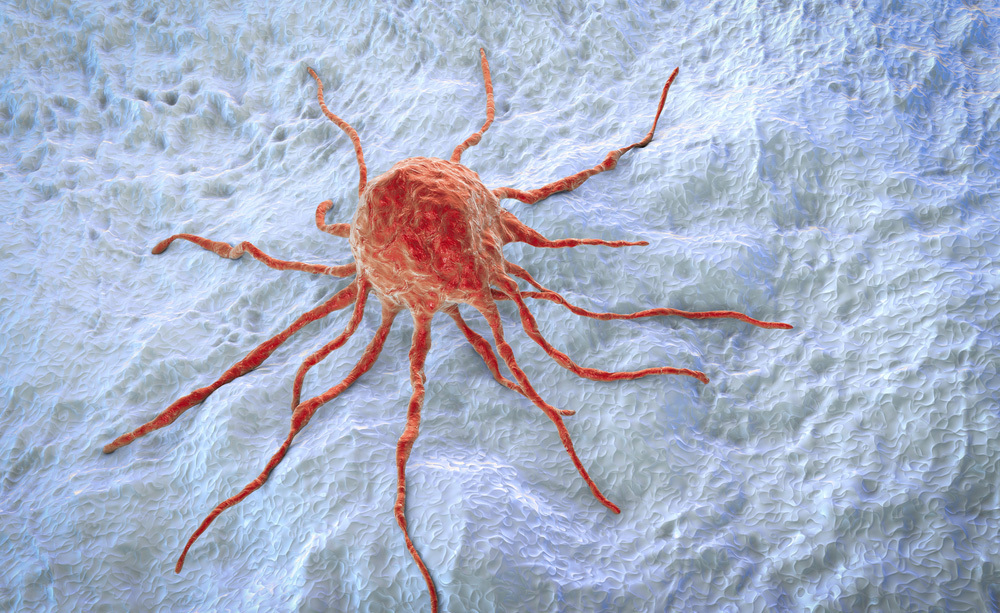 tumore al colon: curarlo