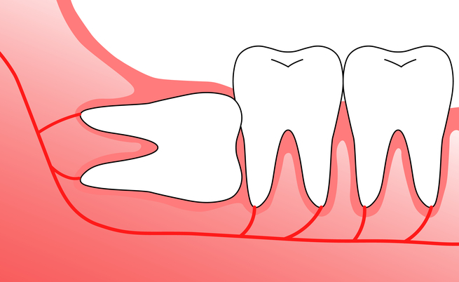 Estrazione del dente del giudizio: ecco come avviene