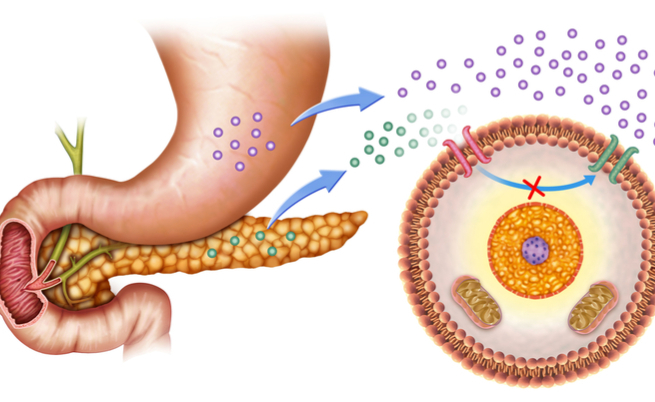 Diabete di tipo 1: ecco una nuova cura