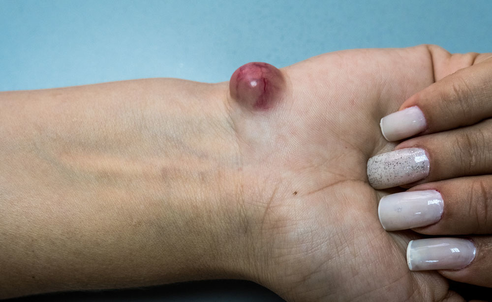 cisti: come riconoscerle