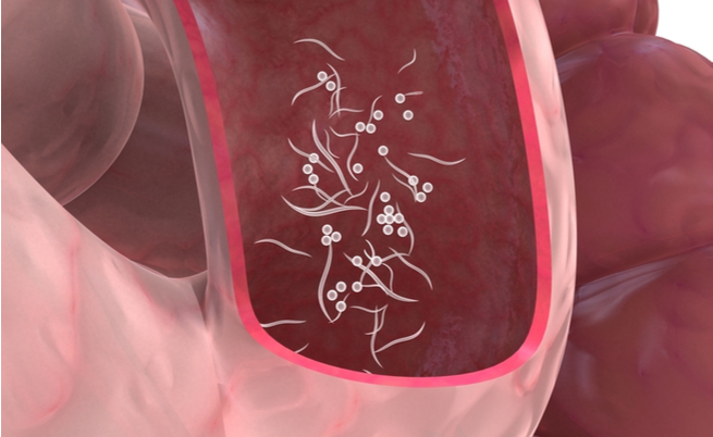 Ossiuri, un'infezione che colpisce i bambin655ccheight=