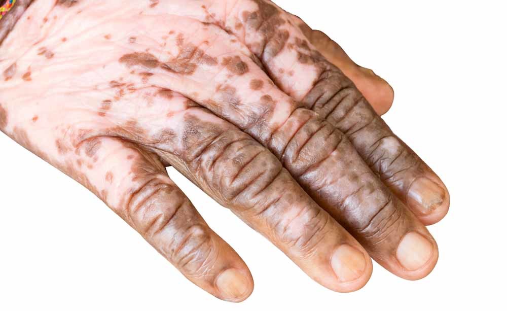 vitiligine vitiligine: le cause