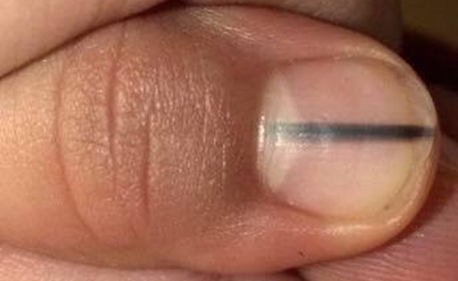 Linea nera sull'unghia? Attenzione, potrebbe essere un melanoma ungueale